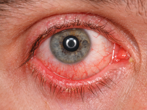 corneal-infections